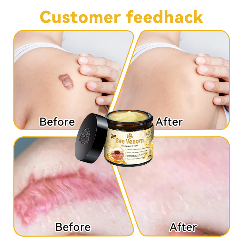 Turonu™ Bee Venom Treatment Cream (🔥Last day promotion 80% off)